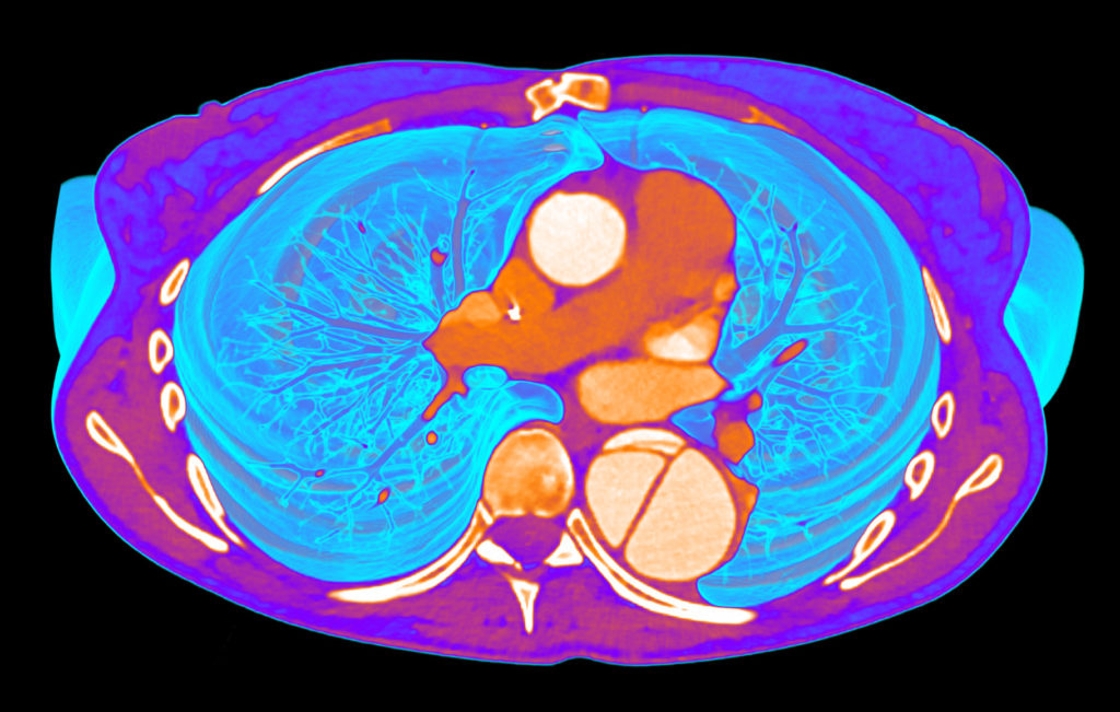 aortic dissection 3d reconstruction ct
