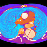 Aortic dissection – 3d reconstruction ct