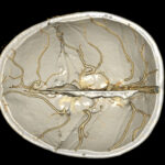 Cerebral Angiography (Brain Angiogram) – CT reconstruction